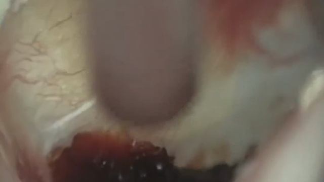 527 — Засохшая кровь на барабанной перепонке удалена после миринготомии | WAXscope®️