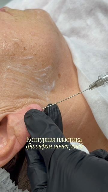 Контурная пластика филлером мочек ушей👂  До/после
