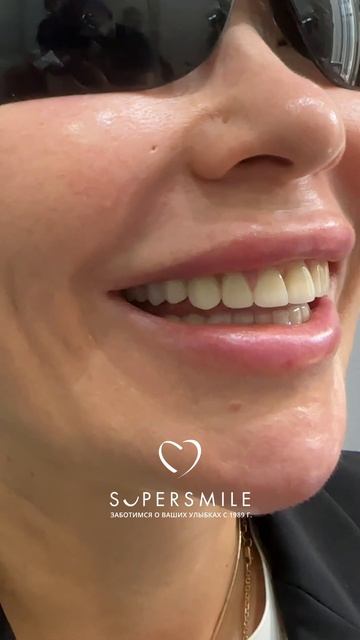 Виниры в клинике Super Smile в СПб
