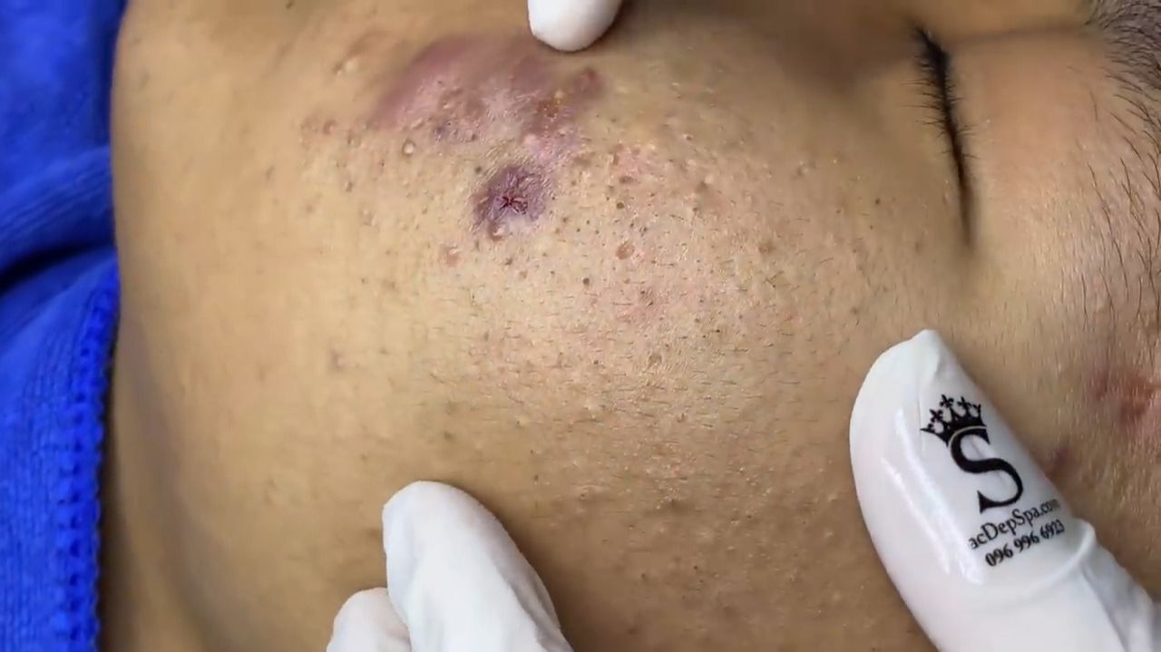471 • Acne Collection • АСМР • Relax Spa