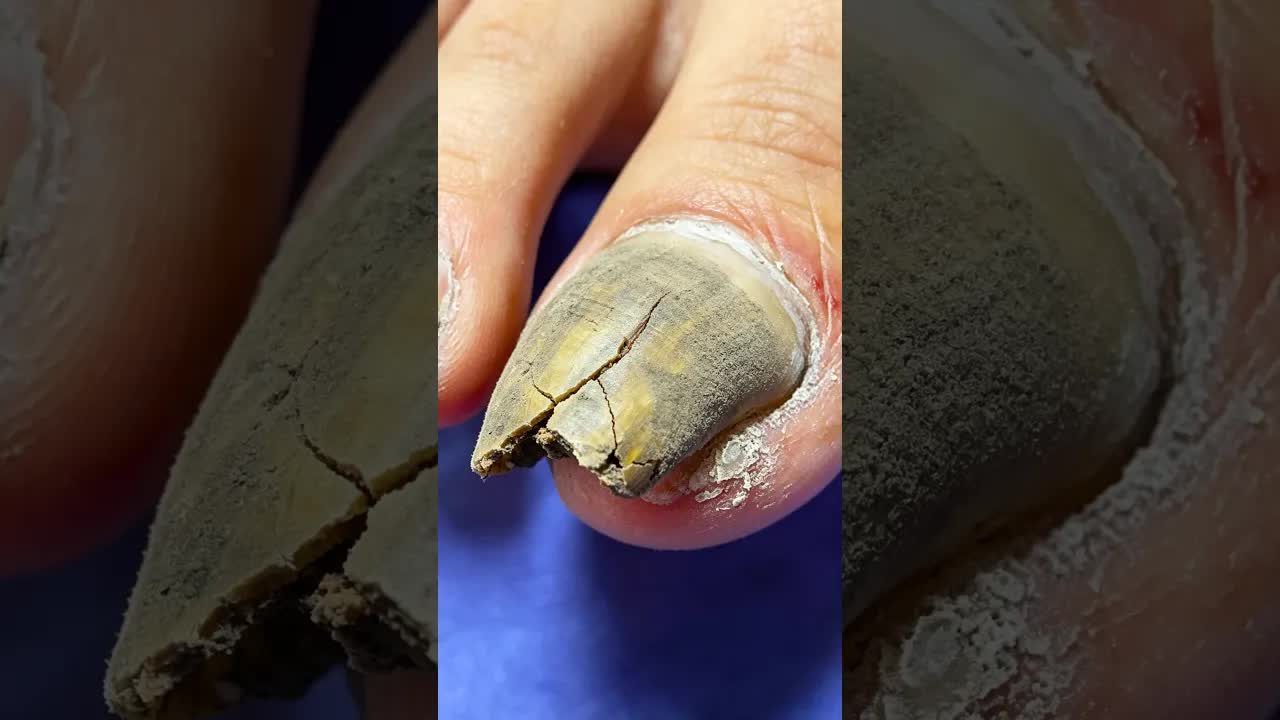 Зеленый онихомикоз, пошаговая обработка~  #satisfying #nails #pimple