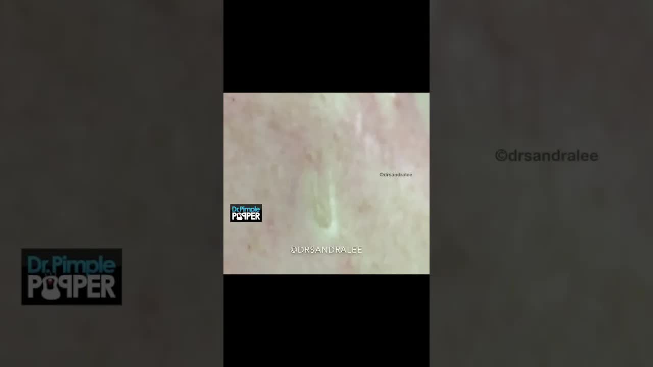 Идеальное выдавливание расширенной поры #drpimplepopper #shorts