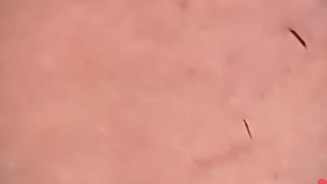 #1236 Удаление комедонов, угрей и прыщей — глубокое очищение кожи