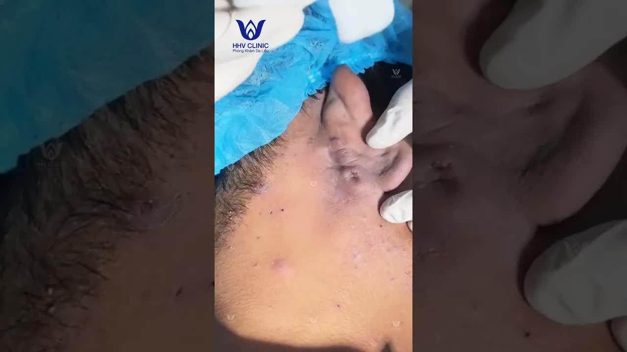 Выдавливание абсцесса в ухе.