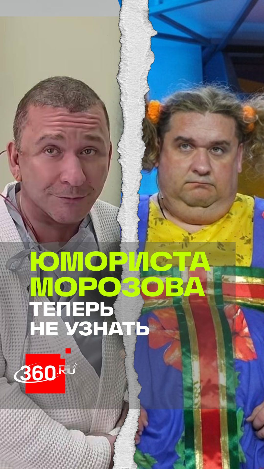 Александр Морозов лег под нож и изменился до неузнаваемости