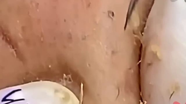 #1237 Удаление комедонов, угрей и прыщей — глубокое очищение кожи