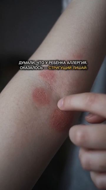 Стригущий лишай или аллергия?