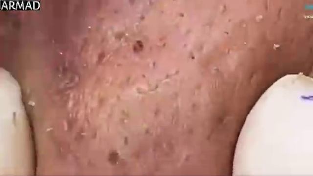 #1230 Удаление комедонов, угрей и прыщей — глубокое очищение кожи
