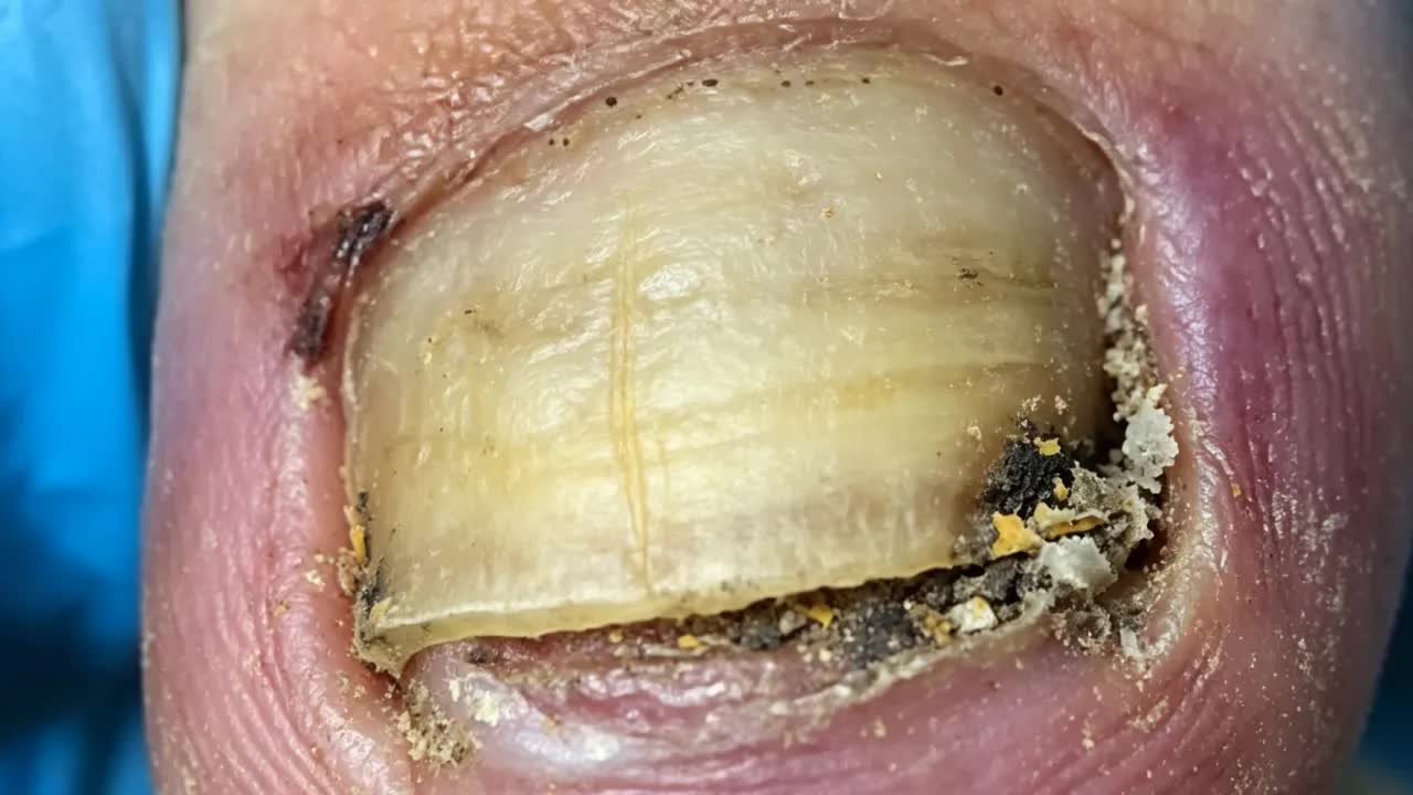Аккуратно подрезаем белые и поврежденные ногти【Безумный педикюр】