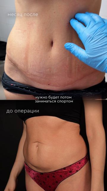 Марина. 37 лет. Волгоград. абдоминопластик и липосакция 360. Месяц после операции.