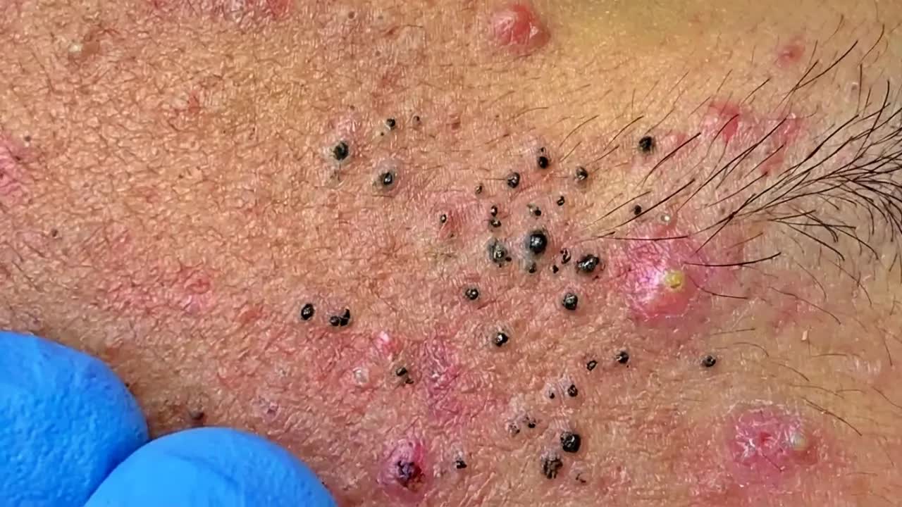 Удаление черных точек в спа-салоне Sac Dep