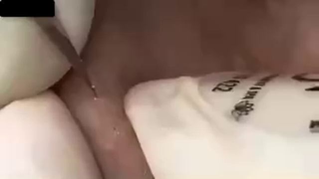 #1234 Удаление комедонов, угрей и прыщей — глубокое очищение кожи