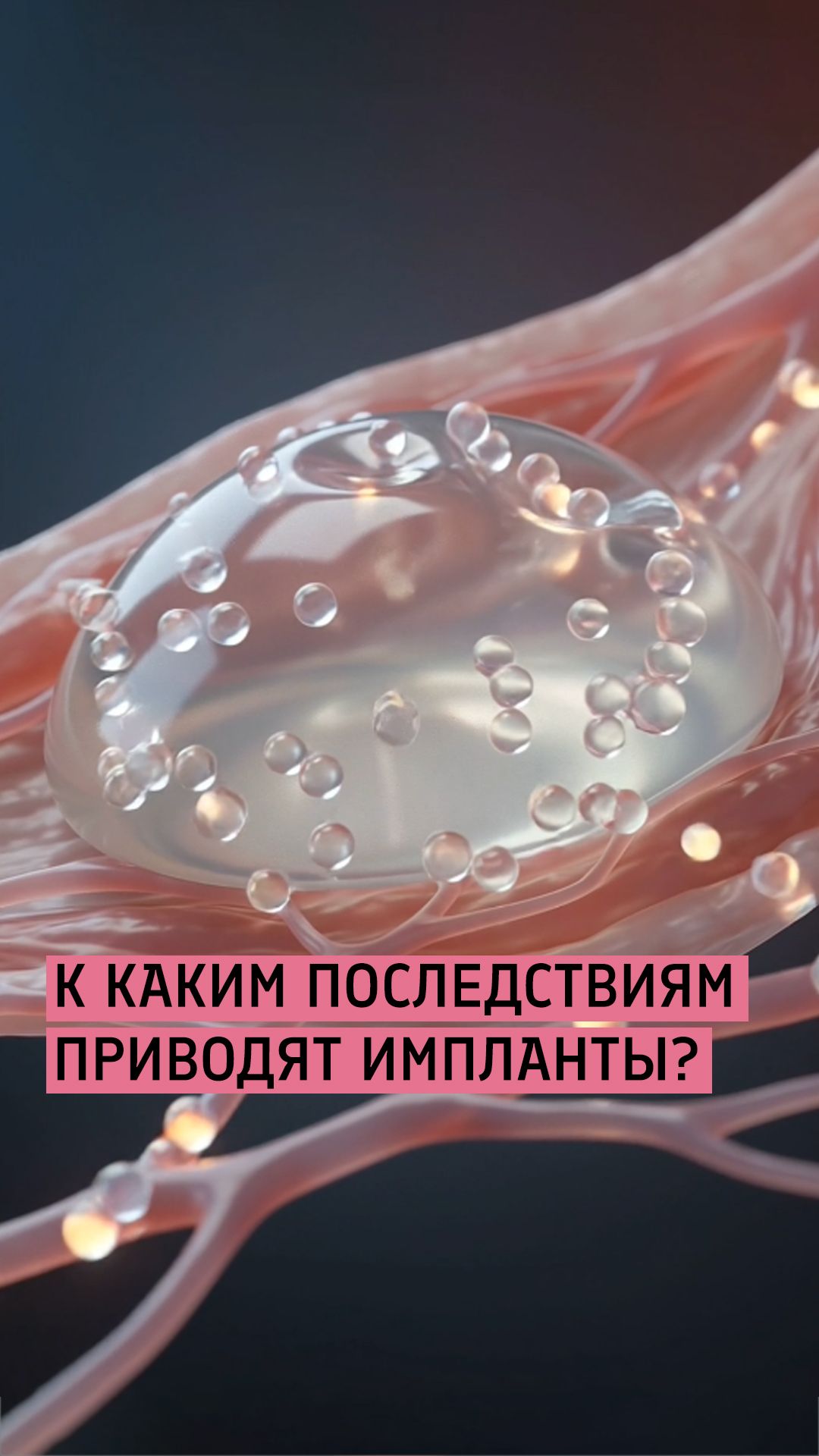 Посмотрите это видео, прежде чем установить импланты / Липофилинг груди / Бурлова Мария Григорьевна