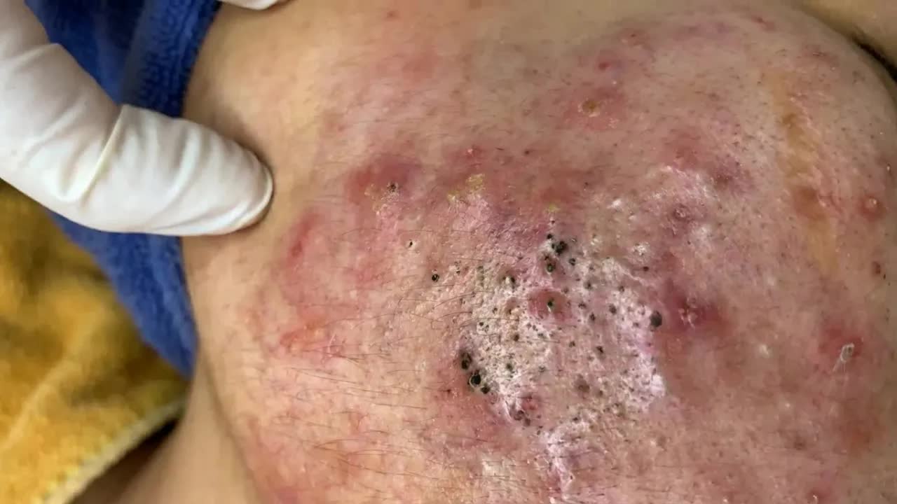 Удаление черных точек в спа-салоне Sac Dep