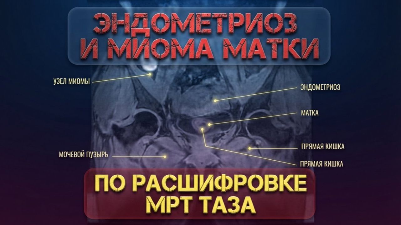 ЭНДОМЕТРИОЗ И МИОМА матки, ПЕРИНЕВРАЛЬНЫЕ КИСТЫ на уровне S2-s3 на РАСШИФРОВКЕ МРТ малого таза