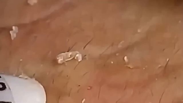 #1235 Удаление комедонов, угрей и прыщей — глубокое очищение кожи