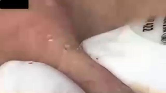 #1233 Удаление комедонов, угрей и прыщей — глубокое очищение кожи