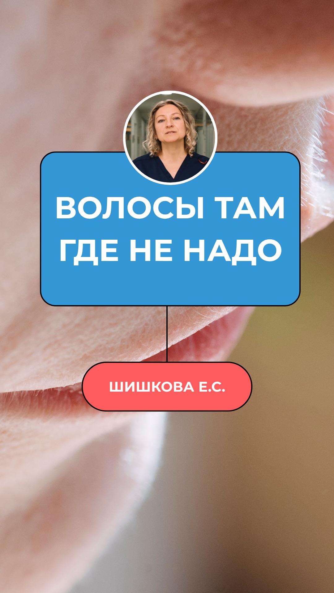 Волосы над губой, на подбородке. Прыщи по челюсти.