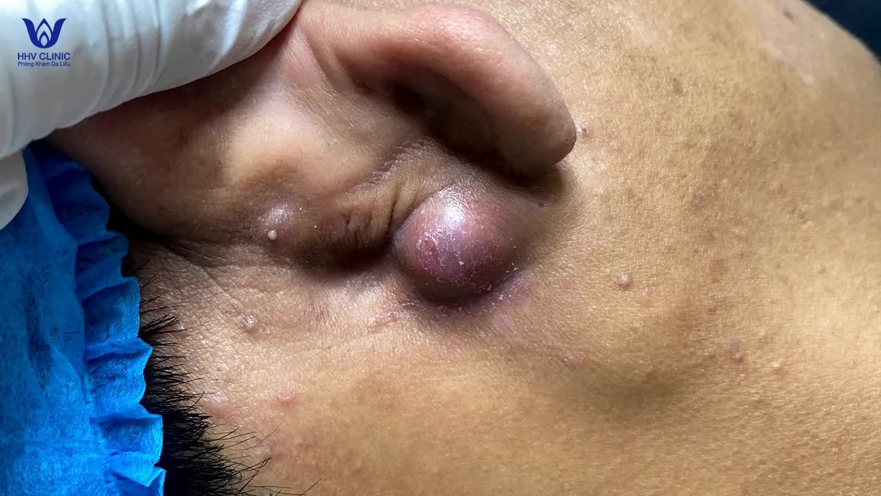 Выдавливание абсцесса на ухе - в клинике дерматологии HHV Clinic.