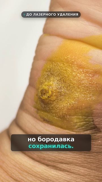 Бородавка сохранилась после домашнего замораживания