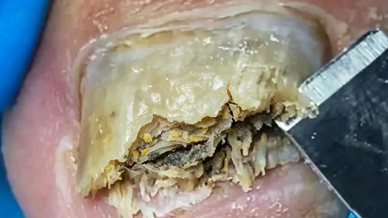 Чёрный онихомикоз маникюр, много грязи【Безумный педикюр】