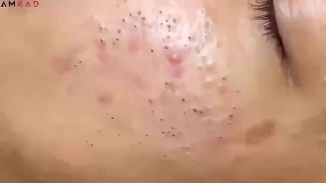 #1238 Удаление комедонов, угрей и прыщей — глубокое очищение кожи