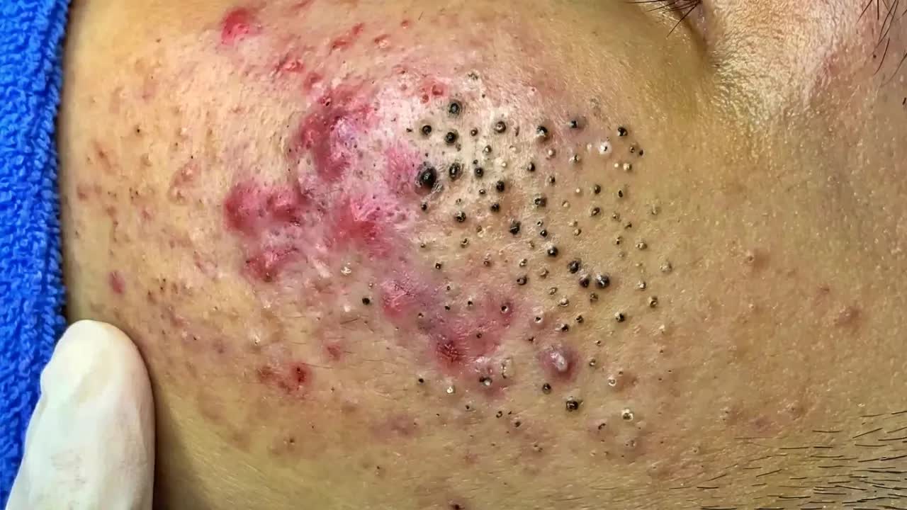 Удаление чёрных точек в спа-салоне Sac Dep