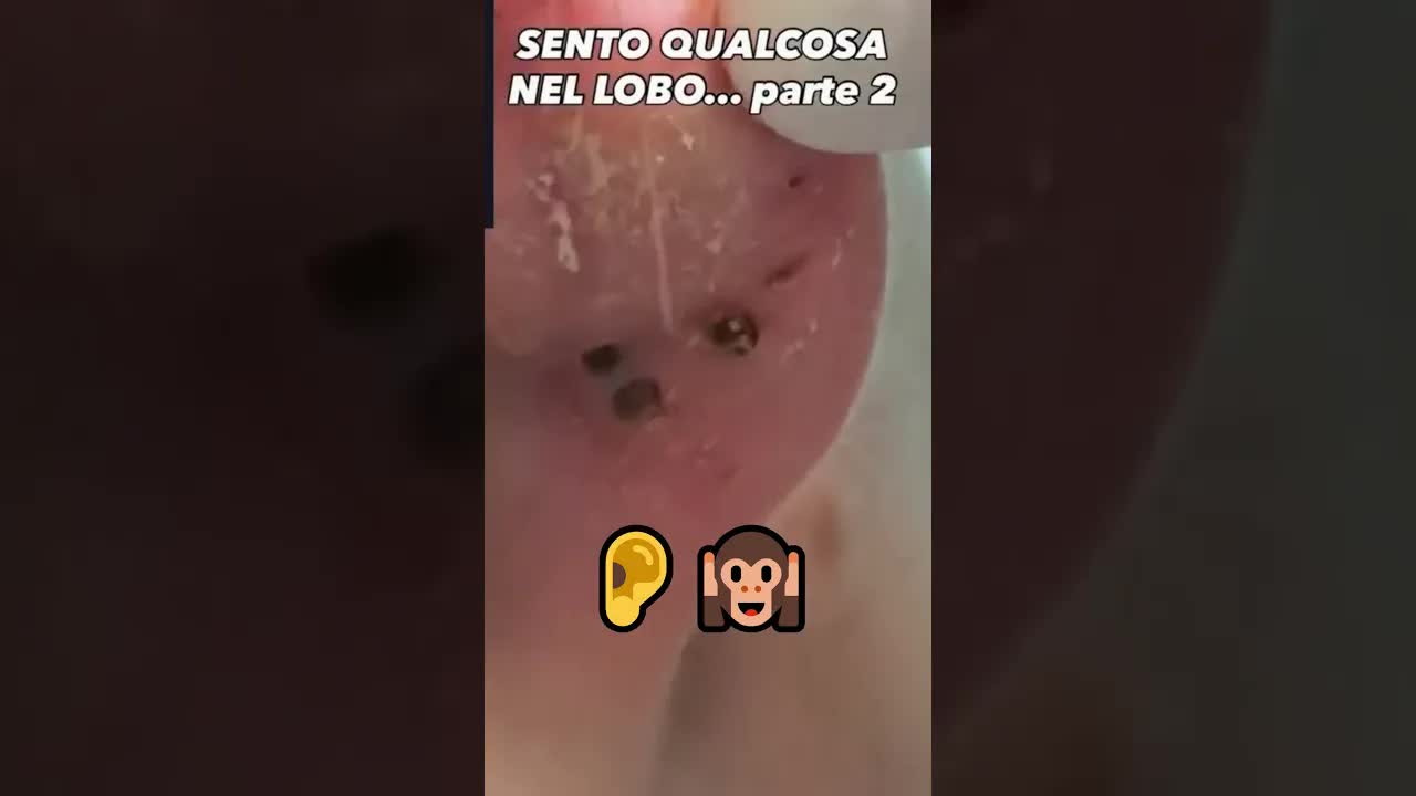 Чистка ушей #pimplepopping #blackheads #satisfying #shortsfeed #viralvideos