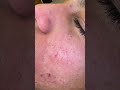 Черные точки на коже
