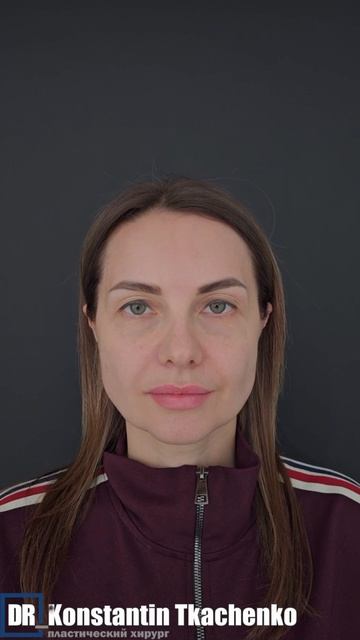Эндоскопическая подтяжка лба и ринопластика😱