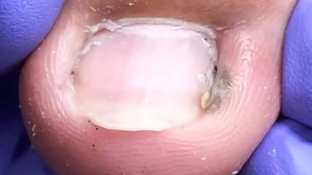 Профессиональное удаление вросших ногтейDoctor Liu Pedicure