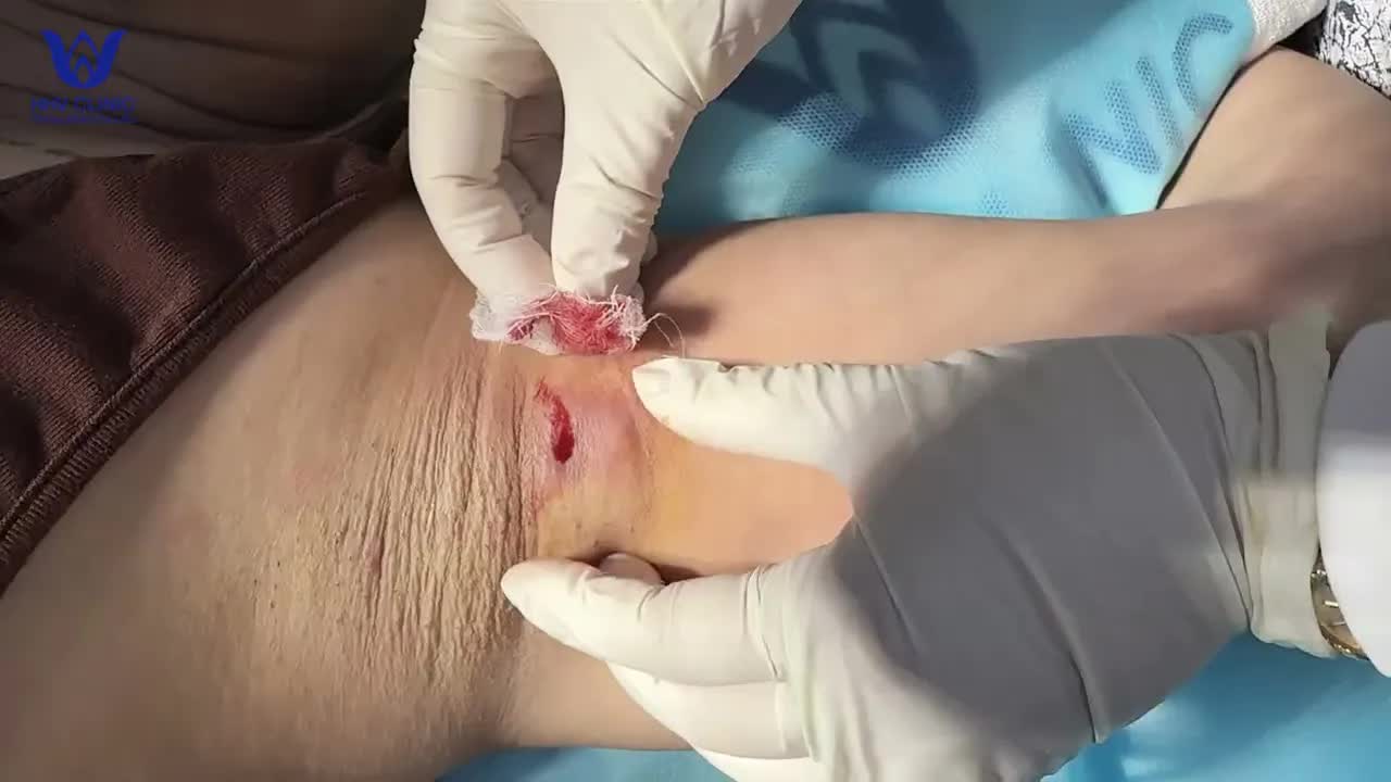 Лечение абсцесса подмышки - в клинике дерматологии HHV Clinic.