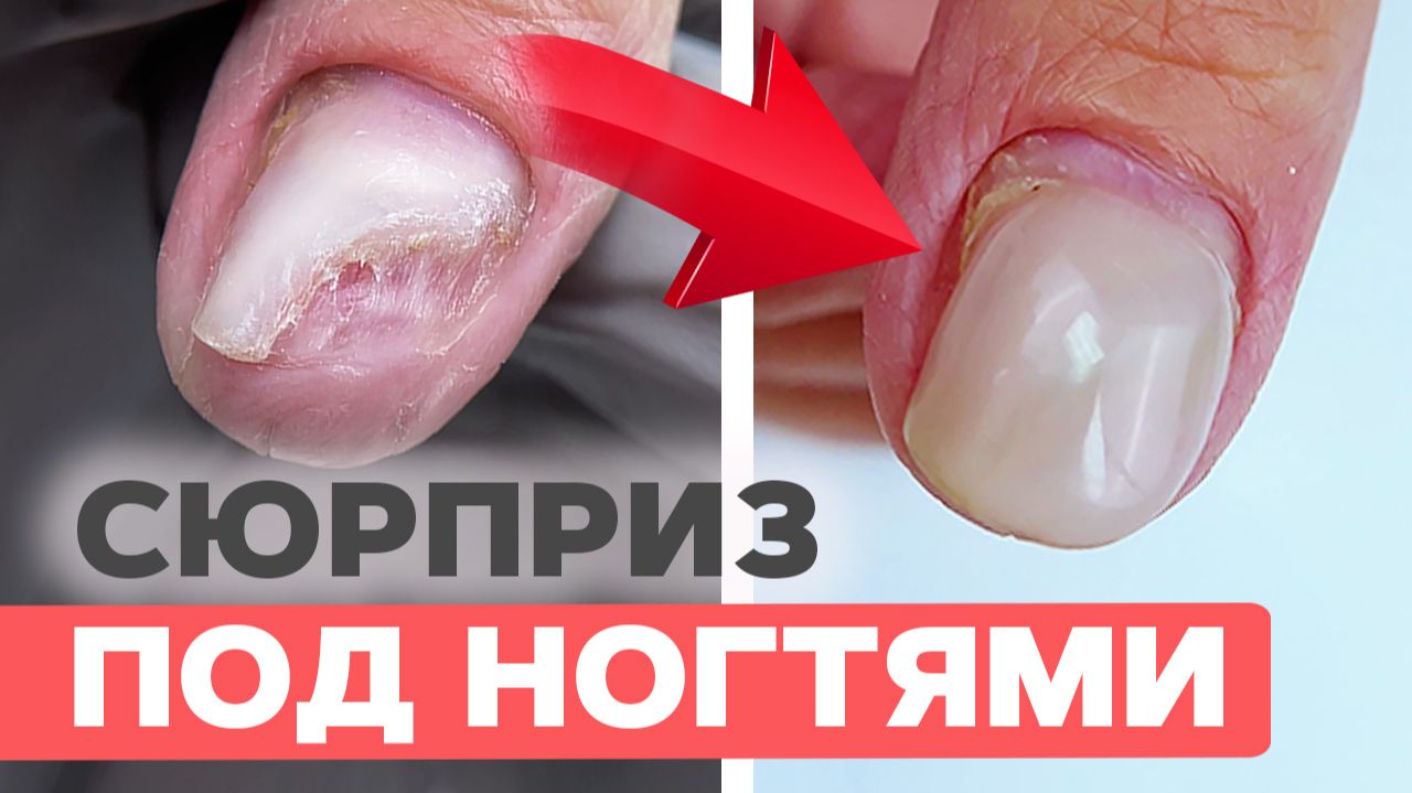 Сложная ногтевая пластина: зачистка и протезирование