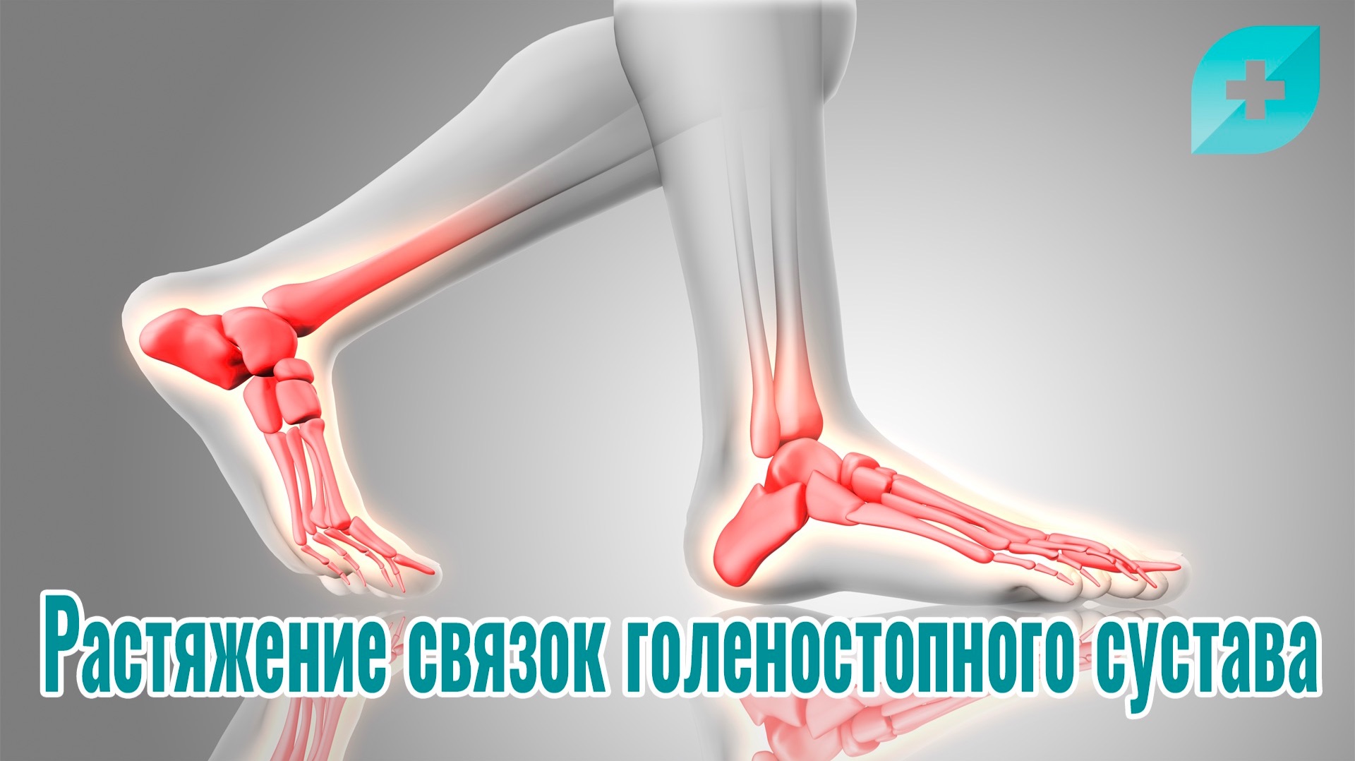 Растяжение связок голеностопного сустава