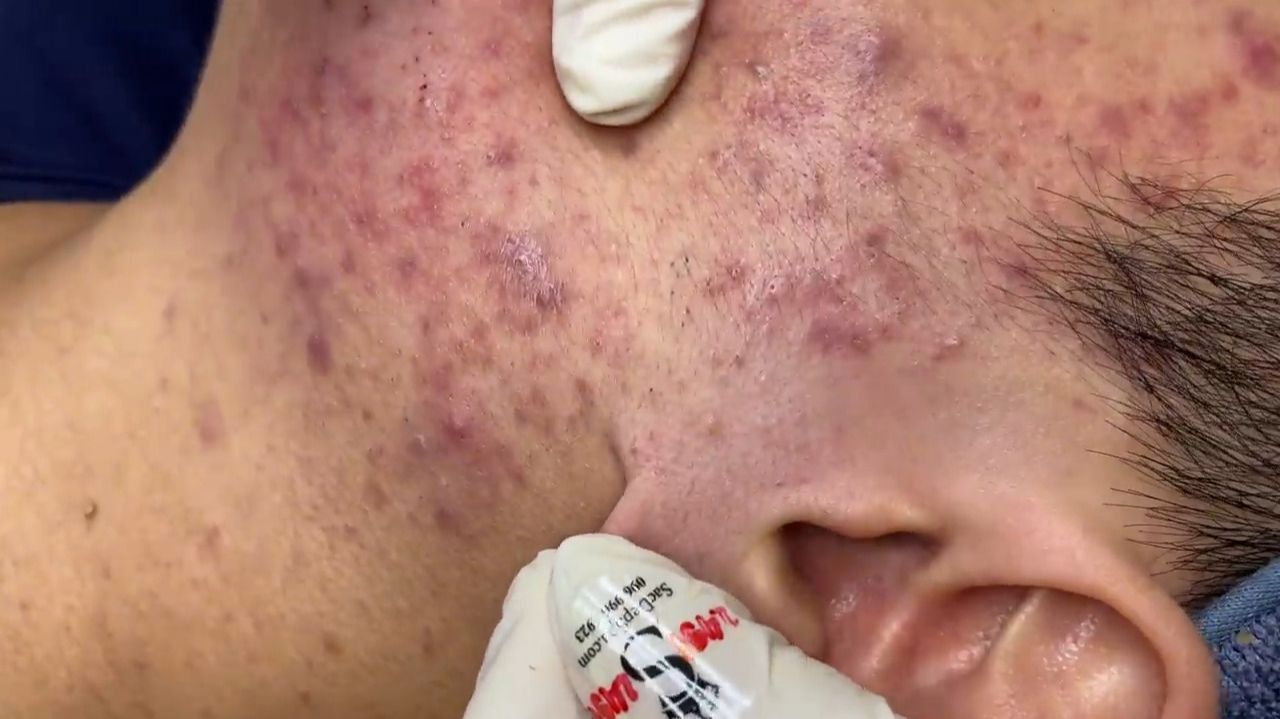 487 • Acne Collection • АСМР • Relax Spa