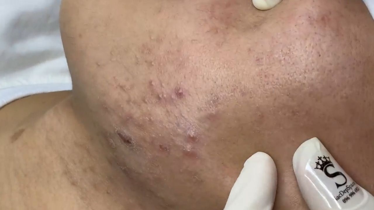 504 • Acne Collection • АСМР • Relax Spa