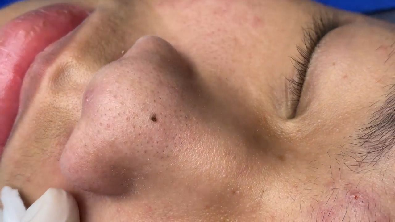 505 • Acne Collection • АСМР • Relax Spa