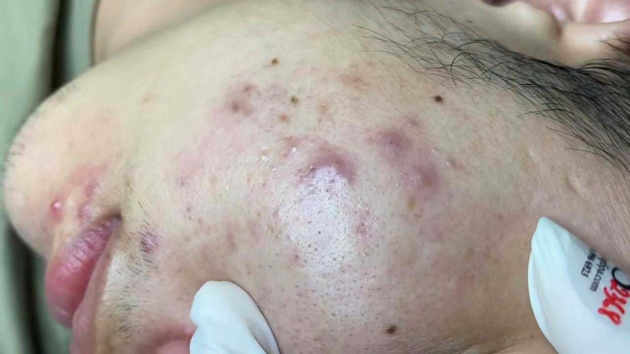 514 • Acne Collection • АСМР • Relax Spa