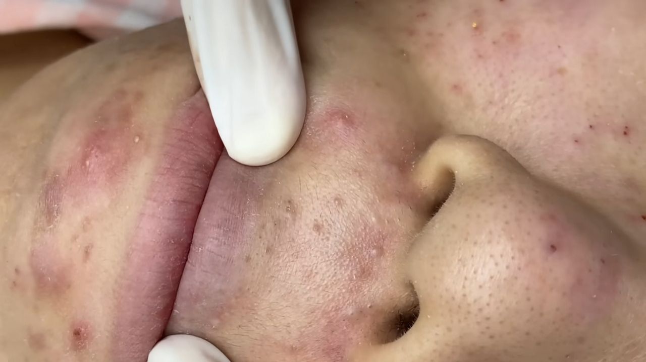 517 • Acne Collection • АСМР • Relax Spa