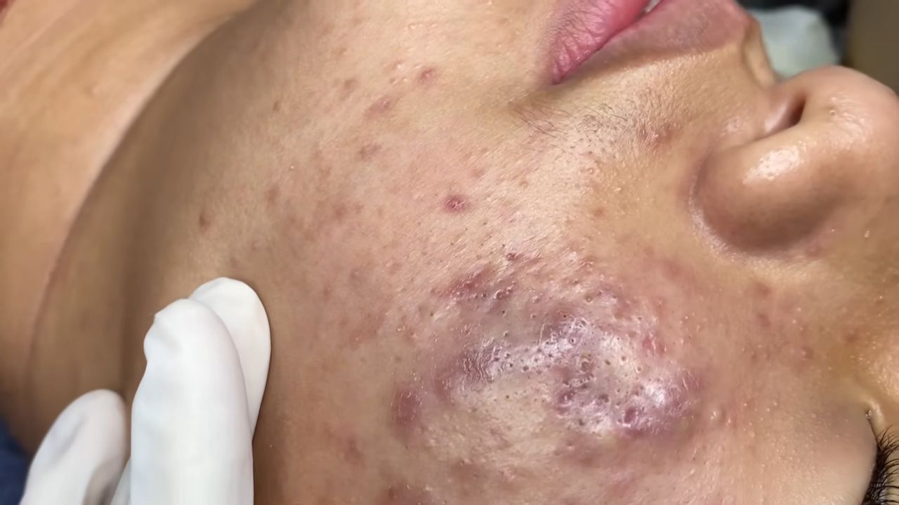513 • Acne Collection • АСМР • Relax Spa