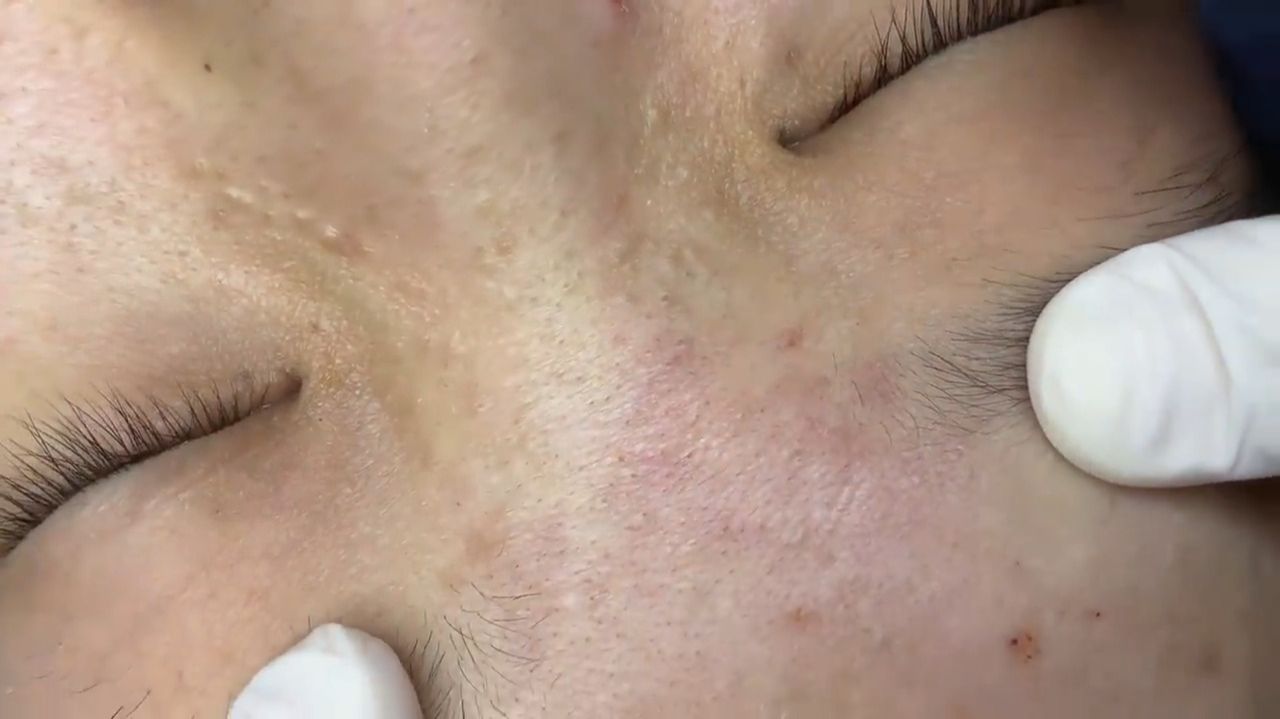 518 • Acne Collection • АСМР • Relax Spa