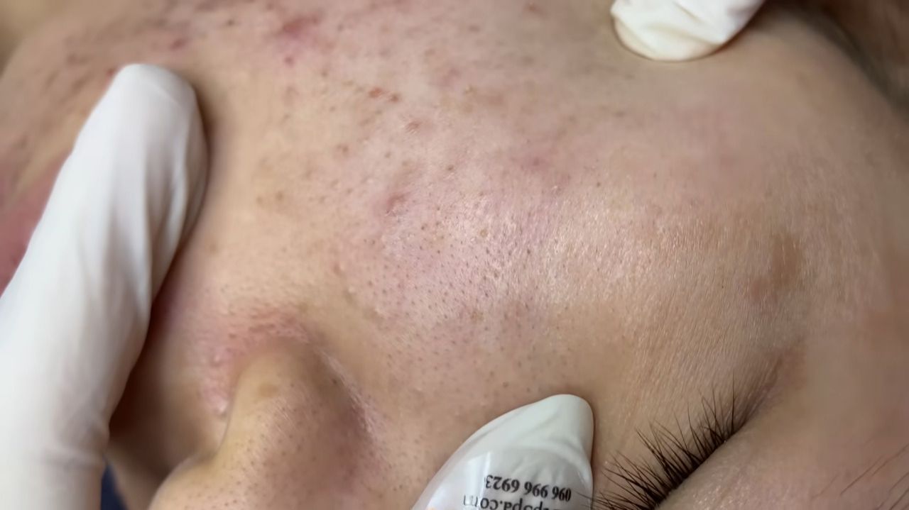 516 • Acne Collection • АСМР • Relax Spa