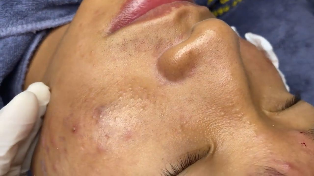 526 • Acne Collection • АСМР • Relax Spa