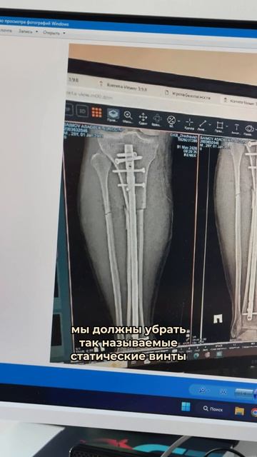 ФИКСАЦИЯ  КОСТИ ПРИ ПЕРЕЛОМЕ