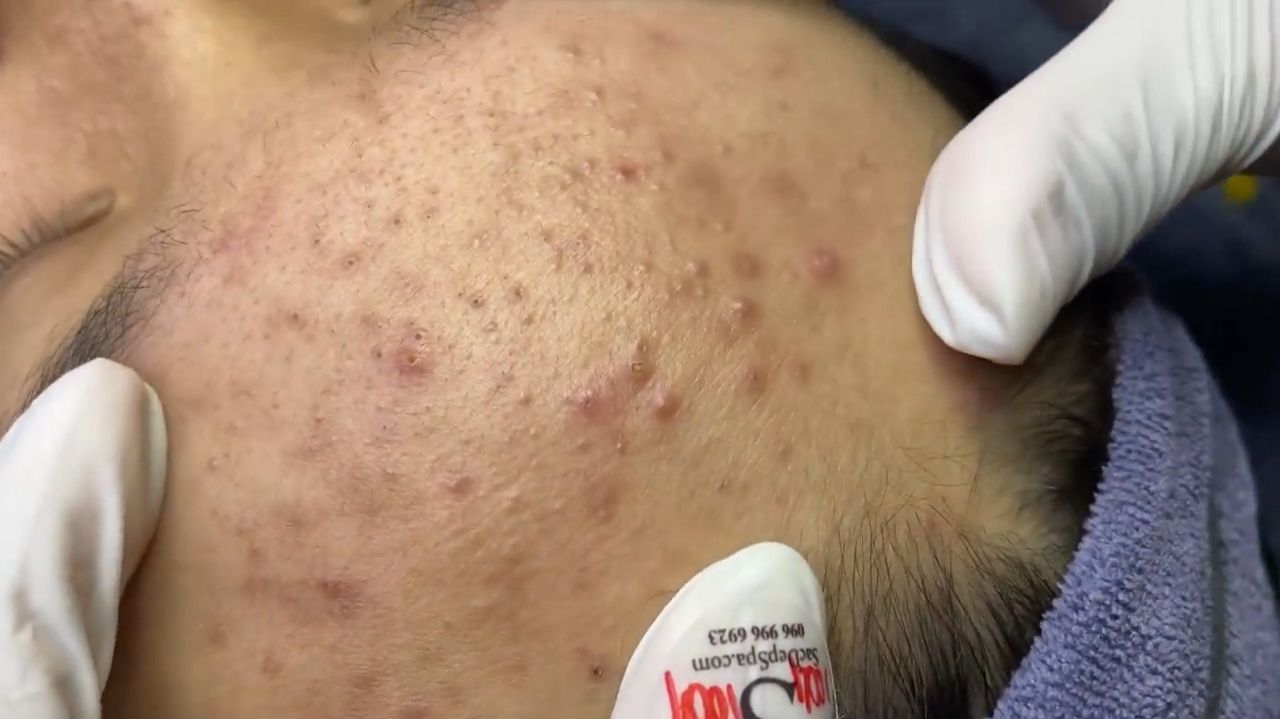 510 • Acne Collection • АСМР • Relax Spa