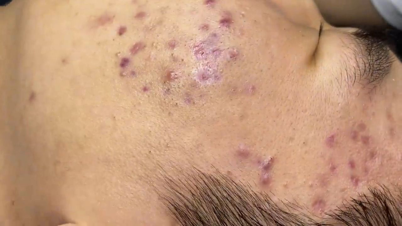 527 • Acne Collection • АСМР • Relax Spa