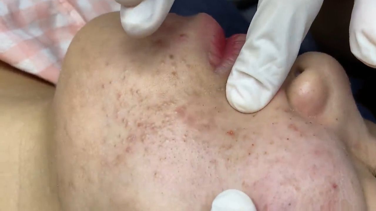524 • Acne Collection • АСМР • Relax Spa