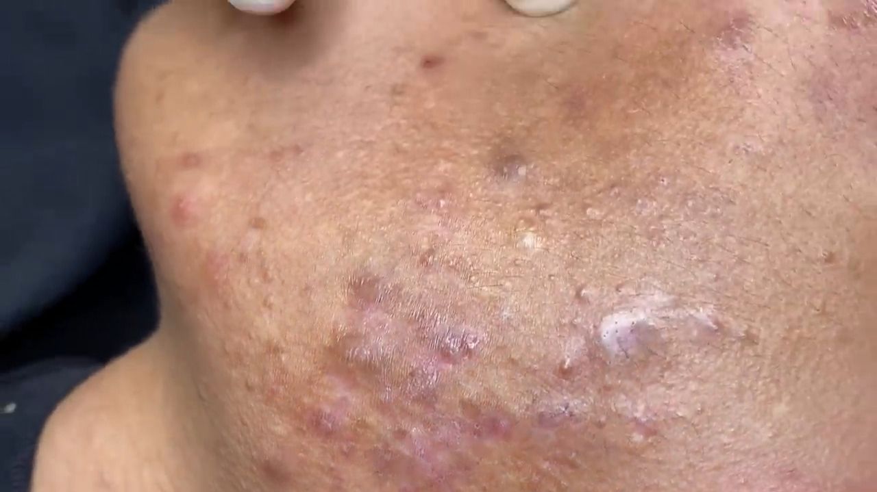 522 • Acne Collection • АСМР • Relax Spa