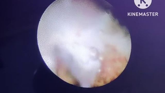 Cystoscopy Cauterization Of Fistulous Tract Between Exstrophy Augment And Closed Off Urethra