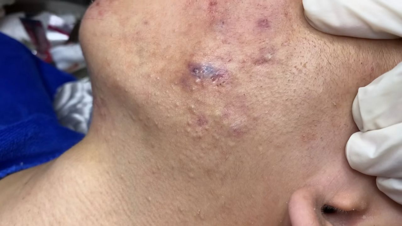 520 • Acne Collection • АСМР • Relax Spa